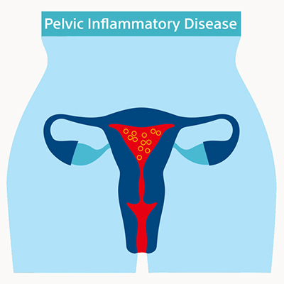 Pelvic Venous Congestion Syndrome